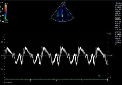 Doku Doppler Görüntüleme (TDI)